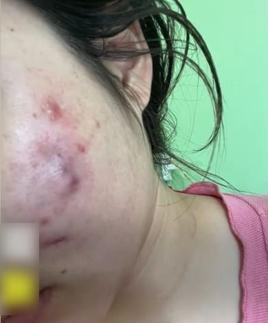 陳女士聽信「一針降顴骨」,讓一名美容博主打美容針, 結果細菌感染毀容,多次治療亦未好轉。(互聯網)
