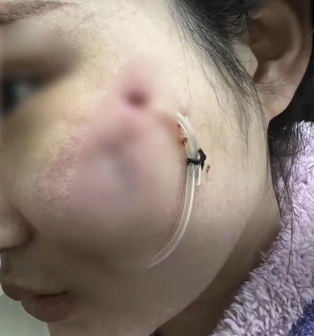 陳女士聽信「一針降顴骨」,讓一名美容博主打美容針, 結果細菌感染毀容,多次治療亦未好轉。(互聯網)