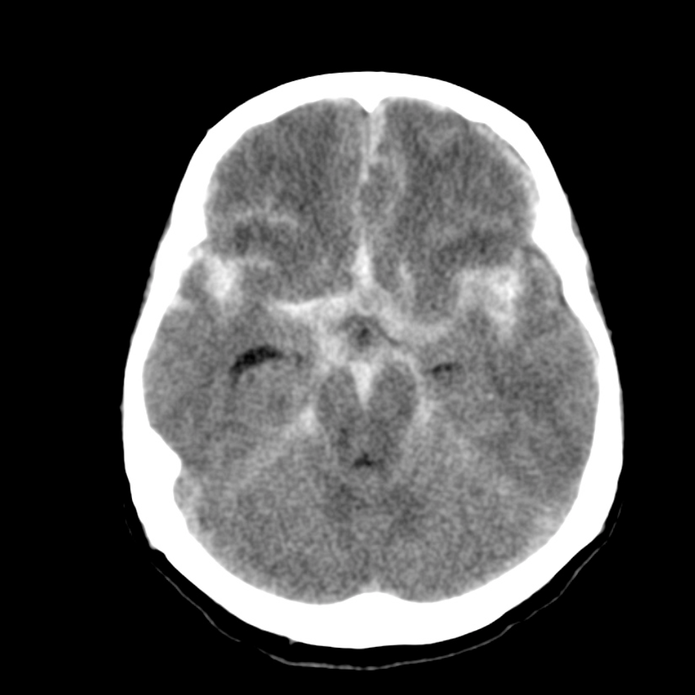 蜘蛛網膜下出血