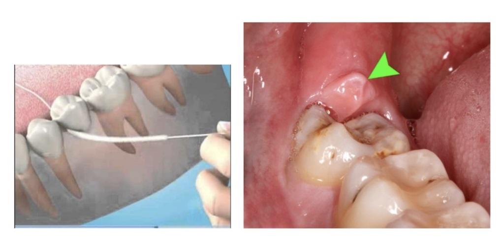 牙橋底部 / 覆蓋在智慧齒上的牙肉