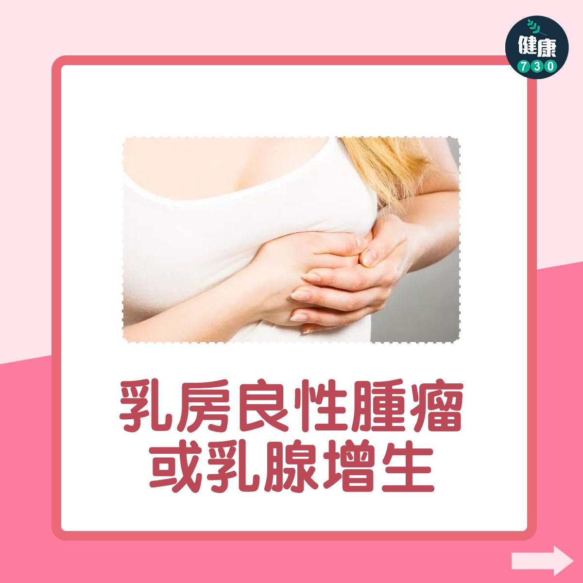 乳房良性腫瘤或乳腺增生