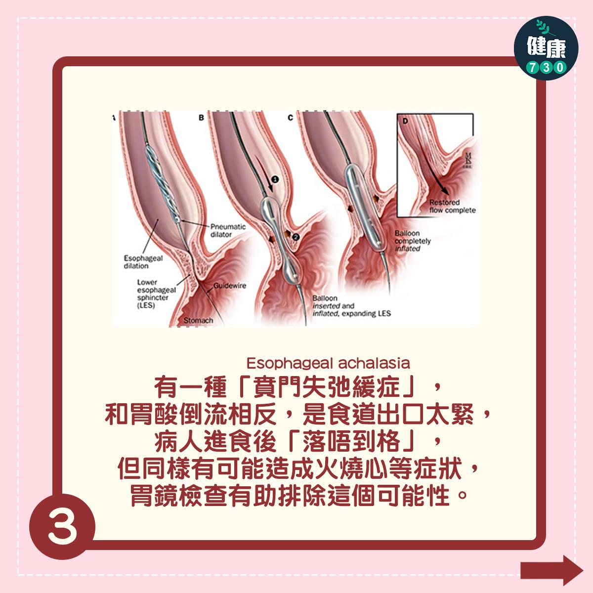 有一種「賁門失弛緩症」(Esophageal achalasia),和胃酸倒流相反,是食道出口太緊,病人進食後「落唔到格」,但同樣有可能造成火燒心等症狀,胃鏡檢查有助排除這個可能性。
