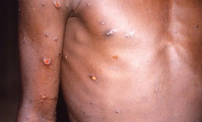 猴痘患者身上長出膿瘡。(資料圖片)