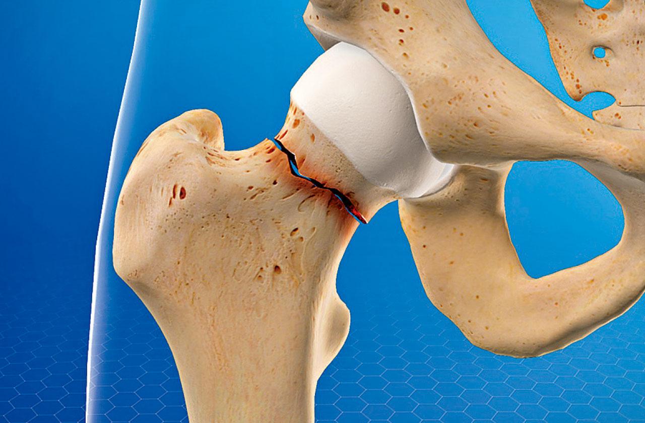 茹素令女性髖骨更易骨折?