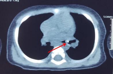 黃皮核卡在小周氣管。(互聯網)