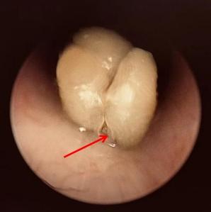 黃皮核卡在小周氣管,還開始發芽。(互聯網)