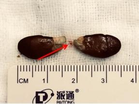 醫生從2歲寶寶小周氣管取出的黃皮核。(互聯網)