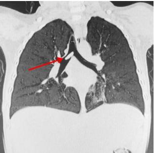 黃皮核卡在小周氣管。(互聯網)