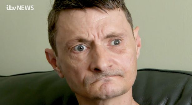 威爾遜雖撿回一命,但身體多個機能已受損。(互聯網)