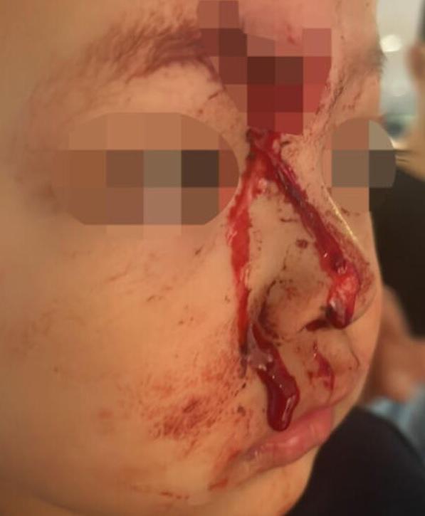 男童滿臉鮮血。(互聯網)
