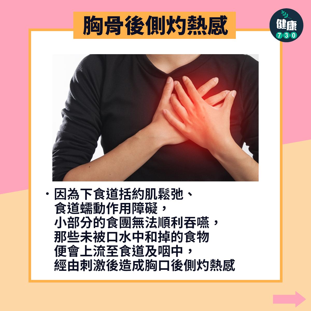 胸骨後側灼熱感