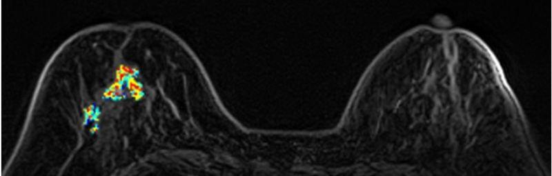 乳房MRI