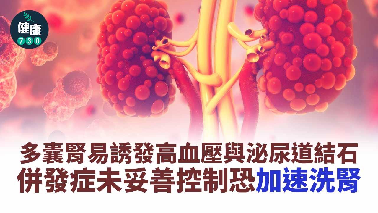 多囊腎是基因遺傳疾病,如果父母親有一位確診,孩子就會有50%風險有同樣疾病,多囊腎發病後,腎臟會不斷長出大小不一水泡,導致患者血管受到水泡壓迫,引起血壓逐漸升高。