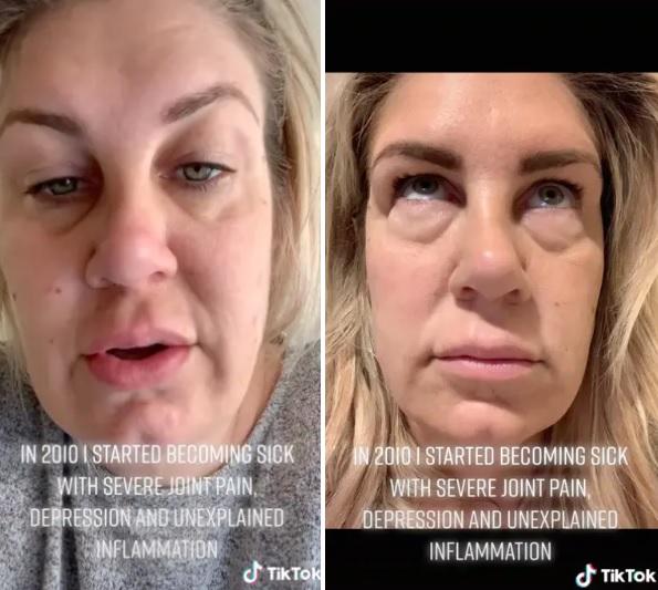 梅利莎說她隆胸後數年出現多種可怕症狀。(互聯網)