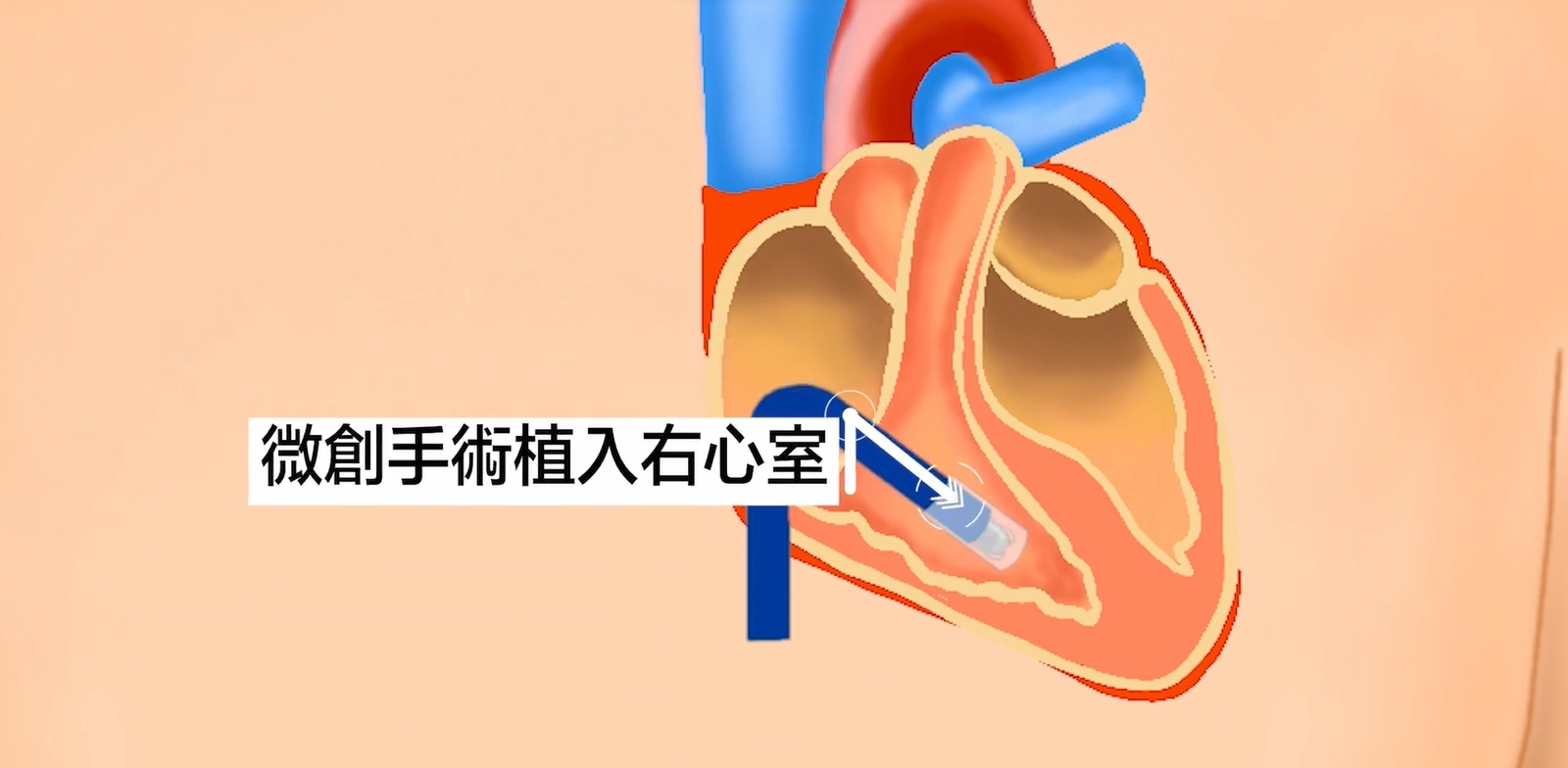 微型無導線起搏器可以經微創方法直接安裝於心臟內,令表面不留安裝痕跡。