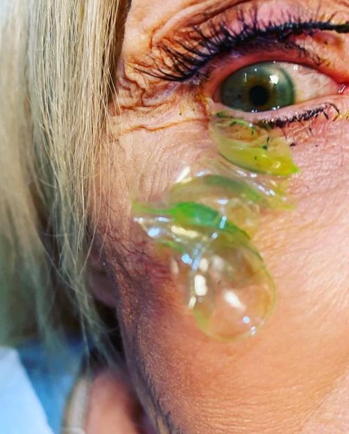 Katerina Kurteeva用棉花棒將隱形眼鏡推出,再用精密的儀械和鑷子將隱形眼鏡分開。(IG)