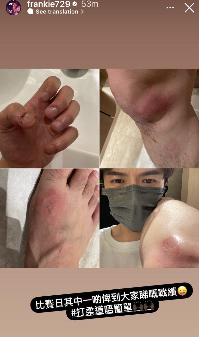 Frankie在IG Story展示練柔道受傷的「戰績」。