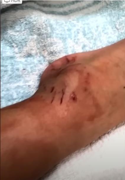 男童腳部被咬傷。(互聯網)