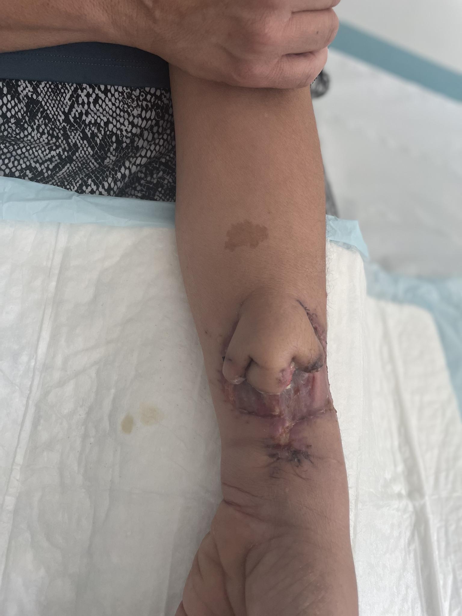 花了2個月時間終於成功培養出一個新鼻。(FB)