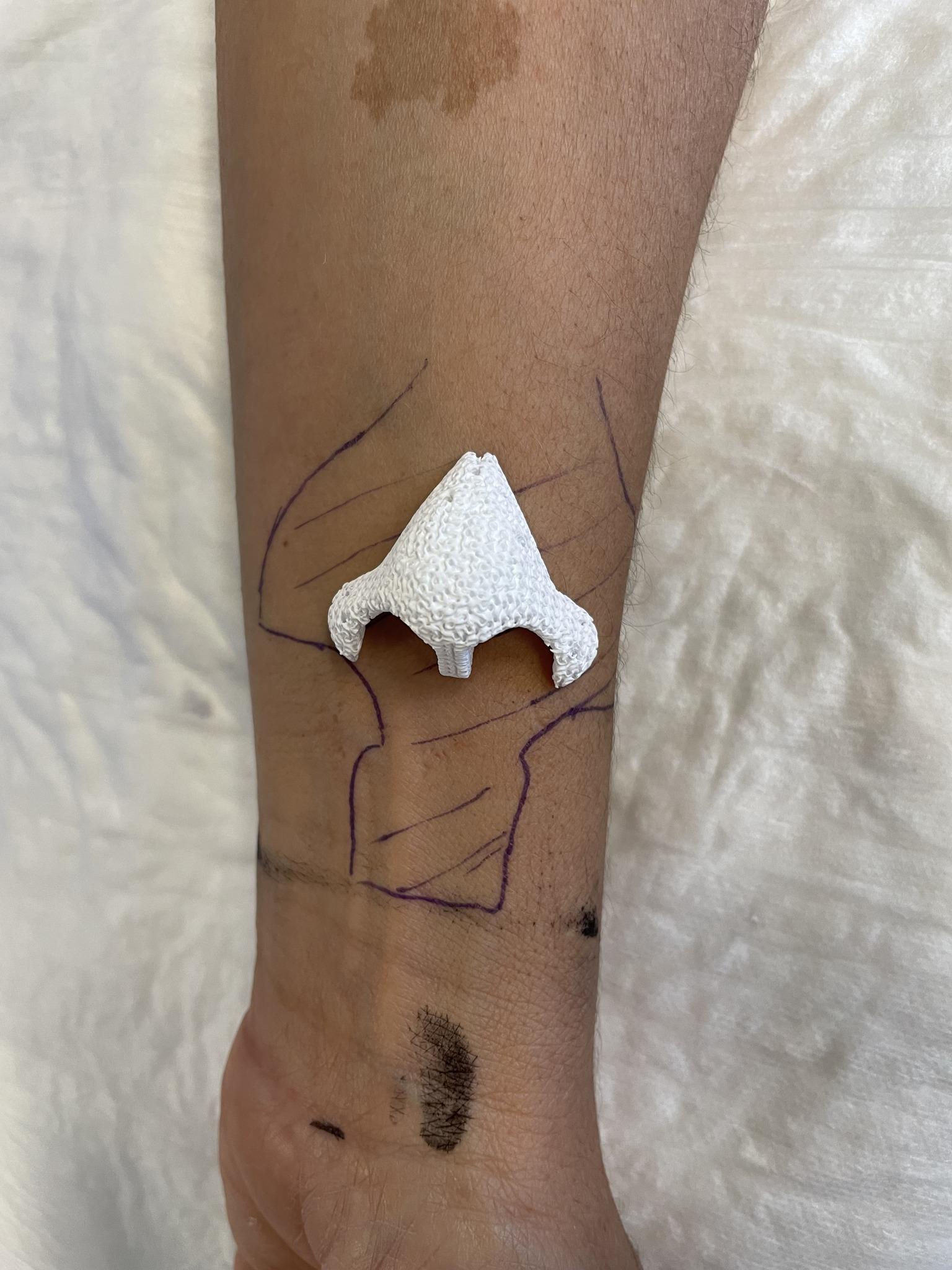 3D打印技術手臂長新鼻,患鼻腔癌女病人鼻哥失而復得。(FB)