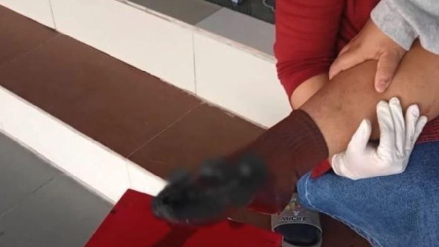 其中一名學生被炸到腳燶受傷。(網上圖片)