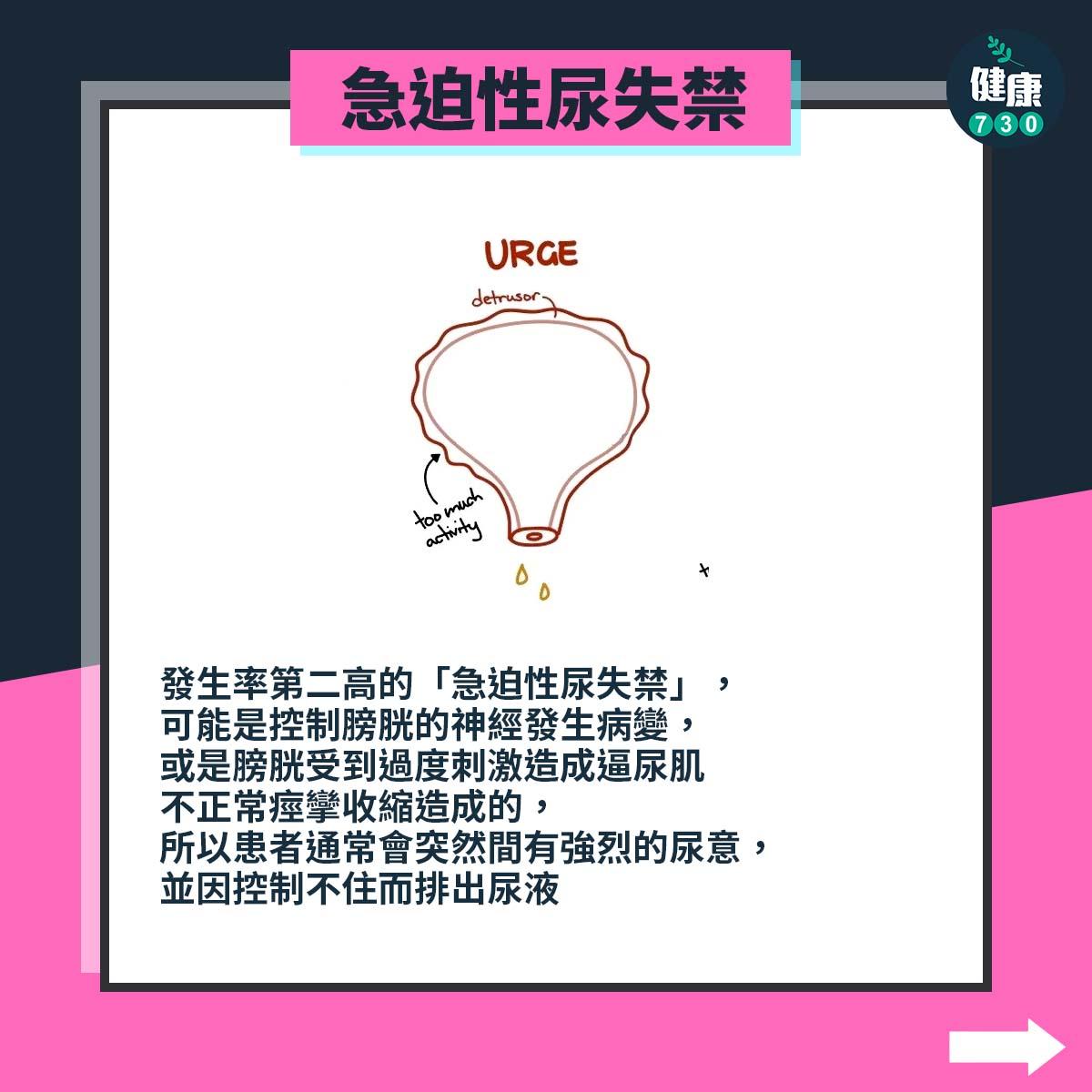 失禁原因|急迫性尿失禁(am730製圖)
