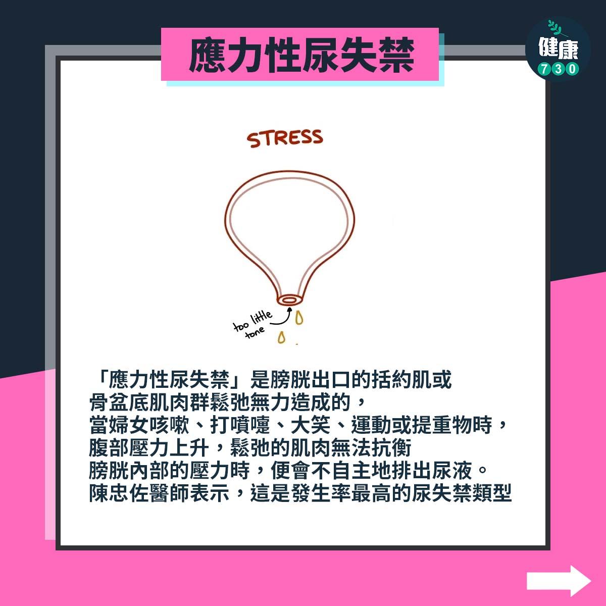 失禁原因|應力性尿失禁(am730製圖)