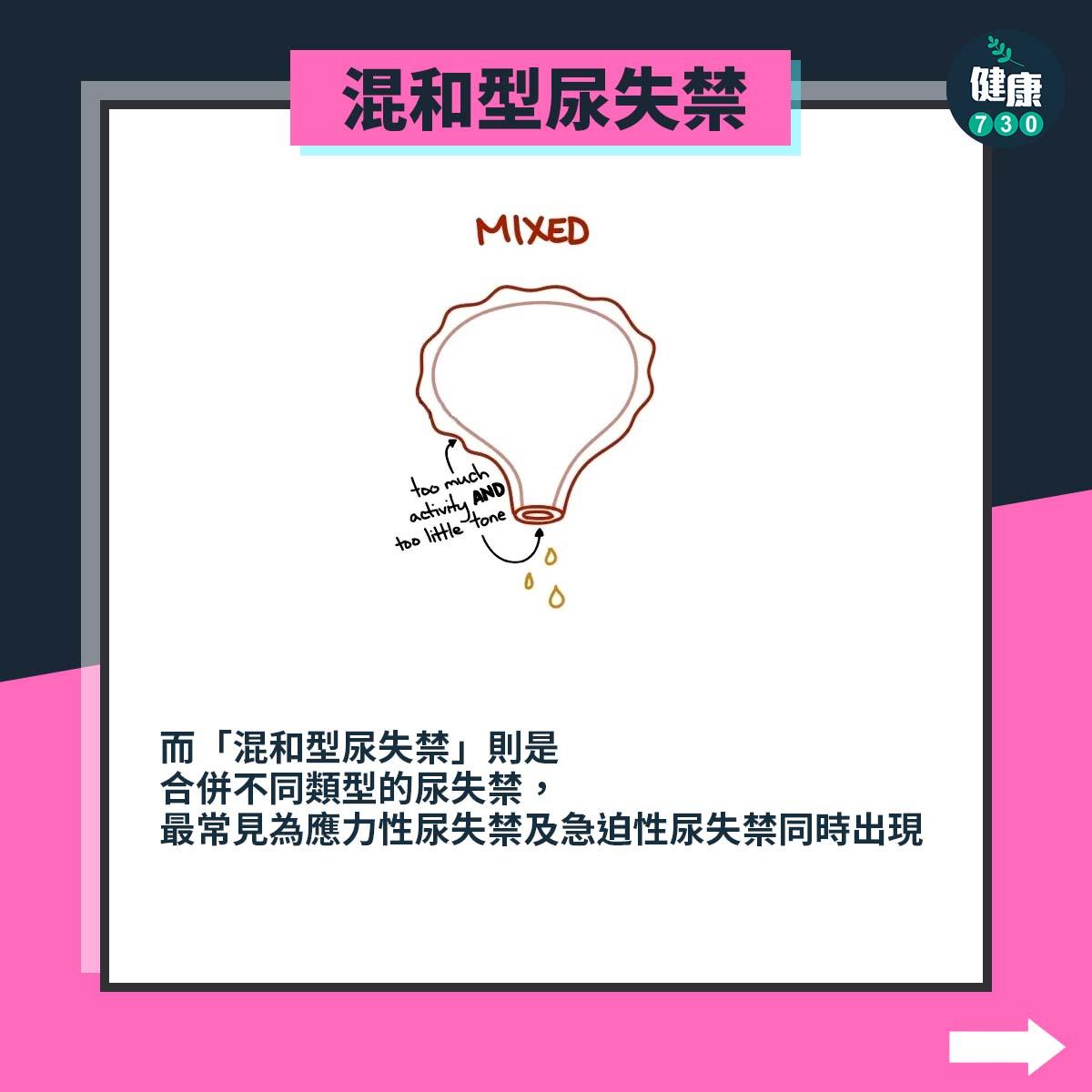失禁原因|混和型尿失禁(am730製圖)