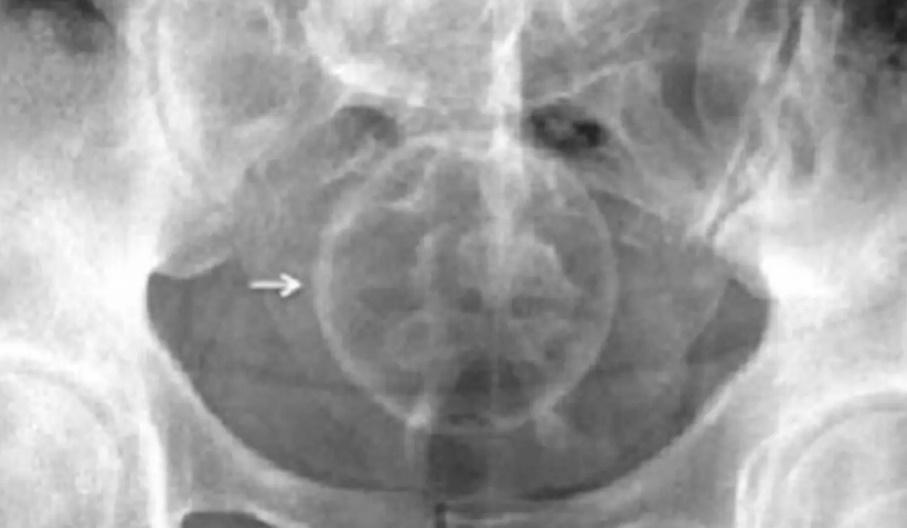 X光片顯示裝飾球卡下體。(網上圖片)