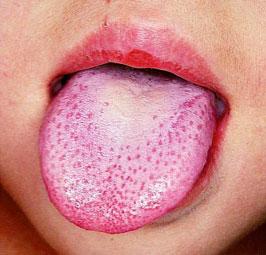猩紅熱病徵包括「草莓舌」。(互聯網)