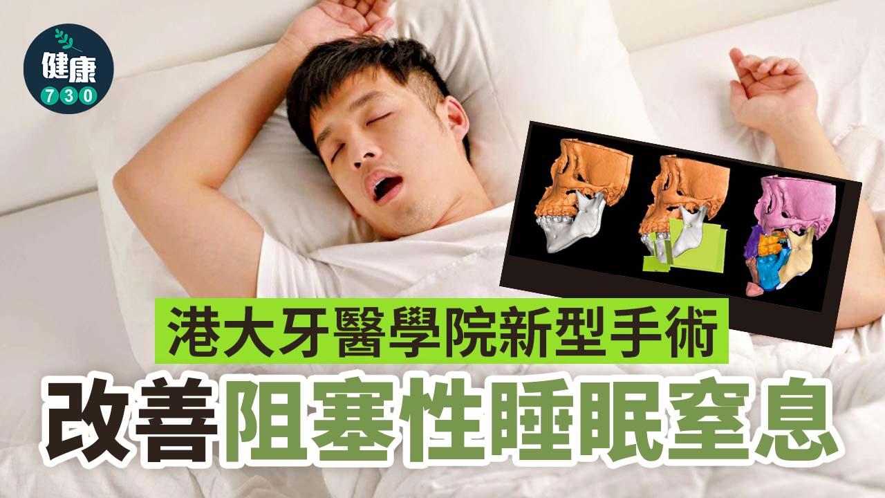 睡眠窒息症|港大牙醫學院新型手術改善阻塞性睡眠窒息