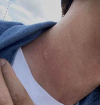 張振朗揸電單車時不幸被蜜蜂螫傷。