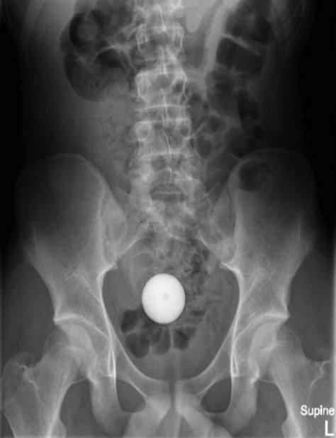 X光顯示,一顆球體卡在腹腔內。(外科病例報告)