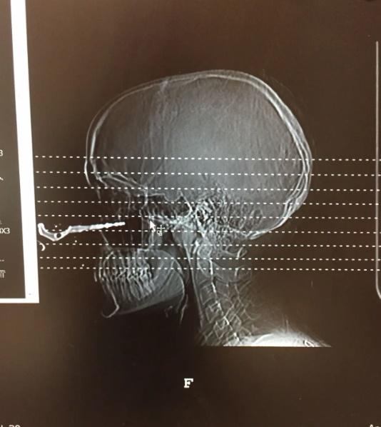 傷勢及意外原因實在太離奇,就連其他科的醫生都趕來一睹這「奇景」,更有醫生要求拍照。(YouTube)
