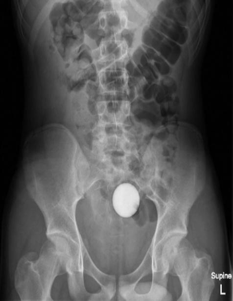 X光顯示,一顆球體卡在腹腔內。(外科病例報告)