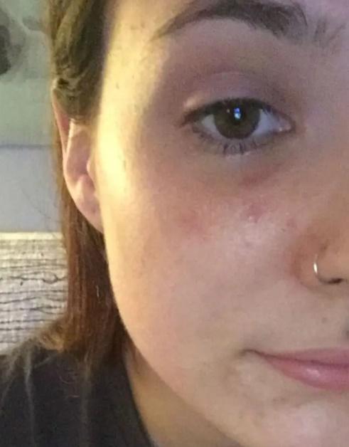 幸好Renée Lariviere的眼睛沒有受影響,臉部的恢復狀況亦非常良好。(YouTube)