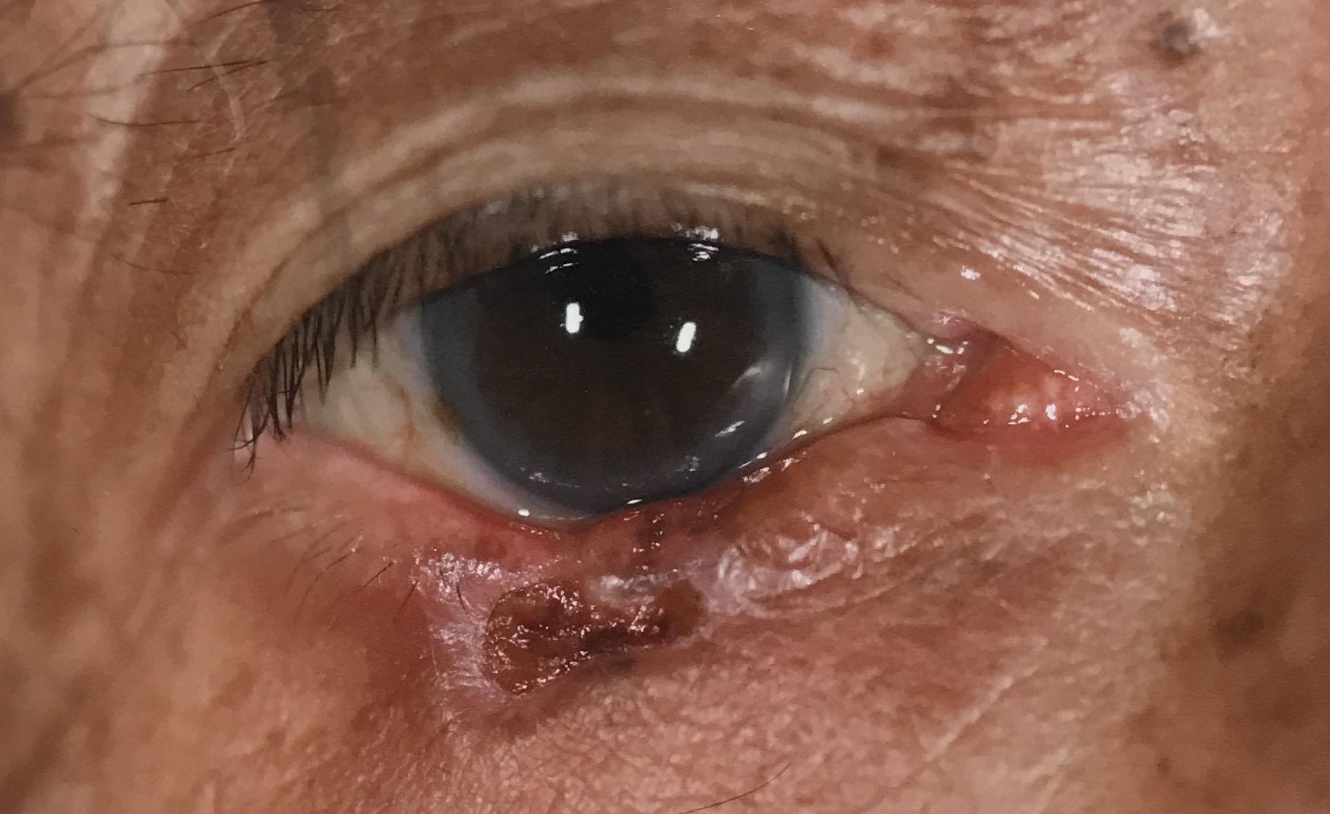 基底細胞瘤的臨床表現