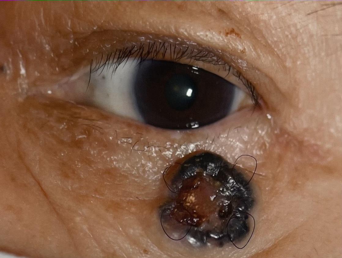 基底細胞瘤的臨床表現