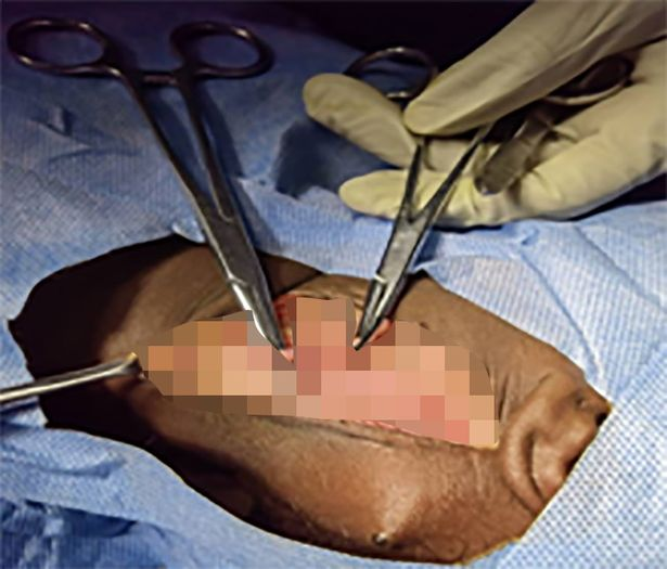 醫生為女童動手術,成功取出髮簪。(互聯網)