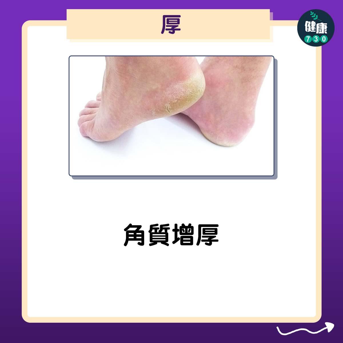 香港腳症狀4大型態(am730)