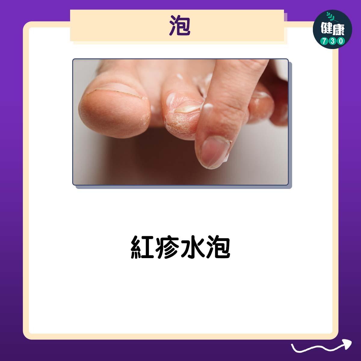 香港腳症狀4大型態(am730)