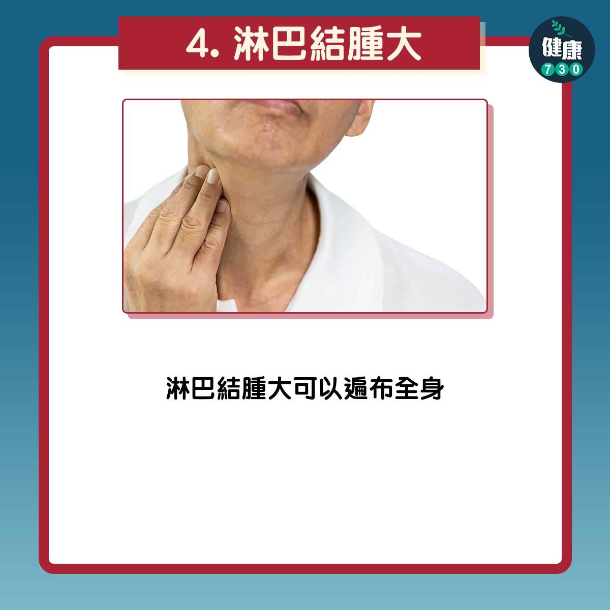 淋巴結腫大:淋巴結腫大可以遍布全身。