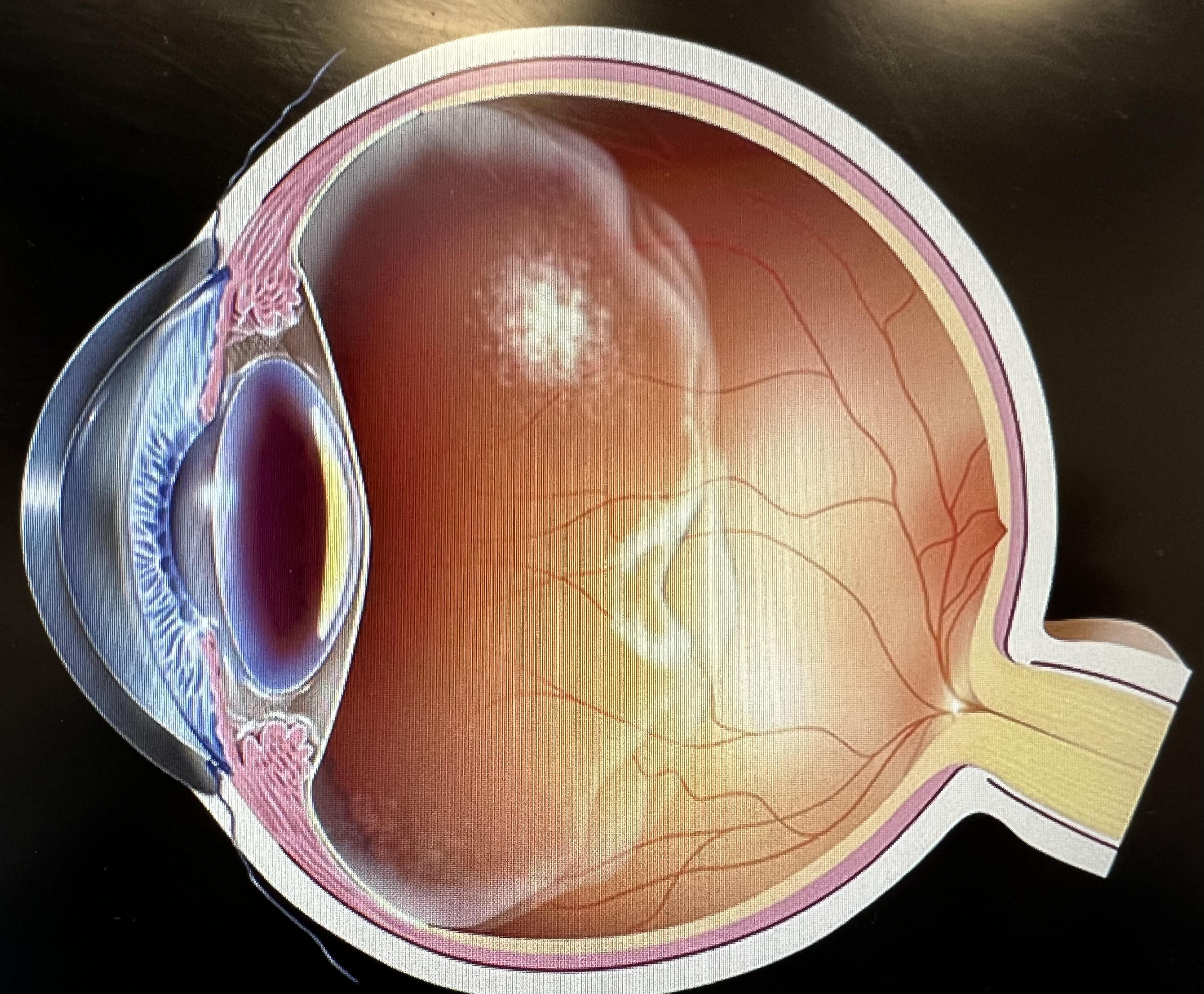 玻璃體後脫離進行中