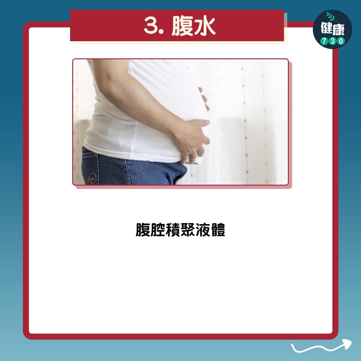 腹水:腹腔積聚液體。