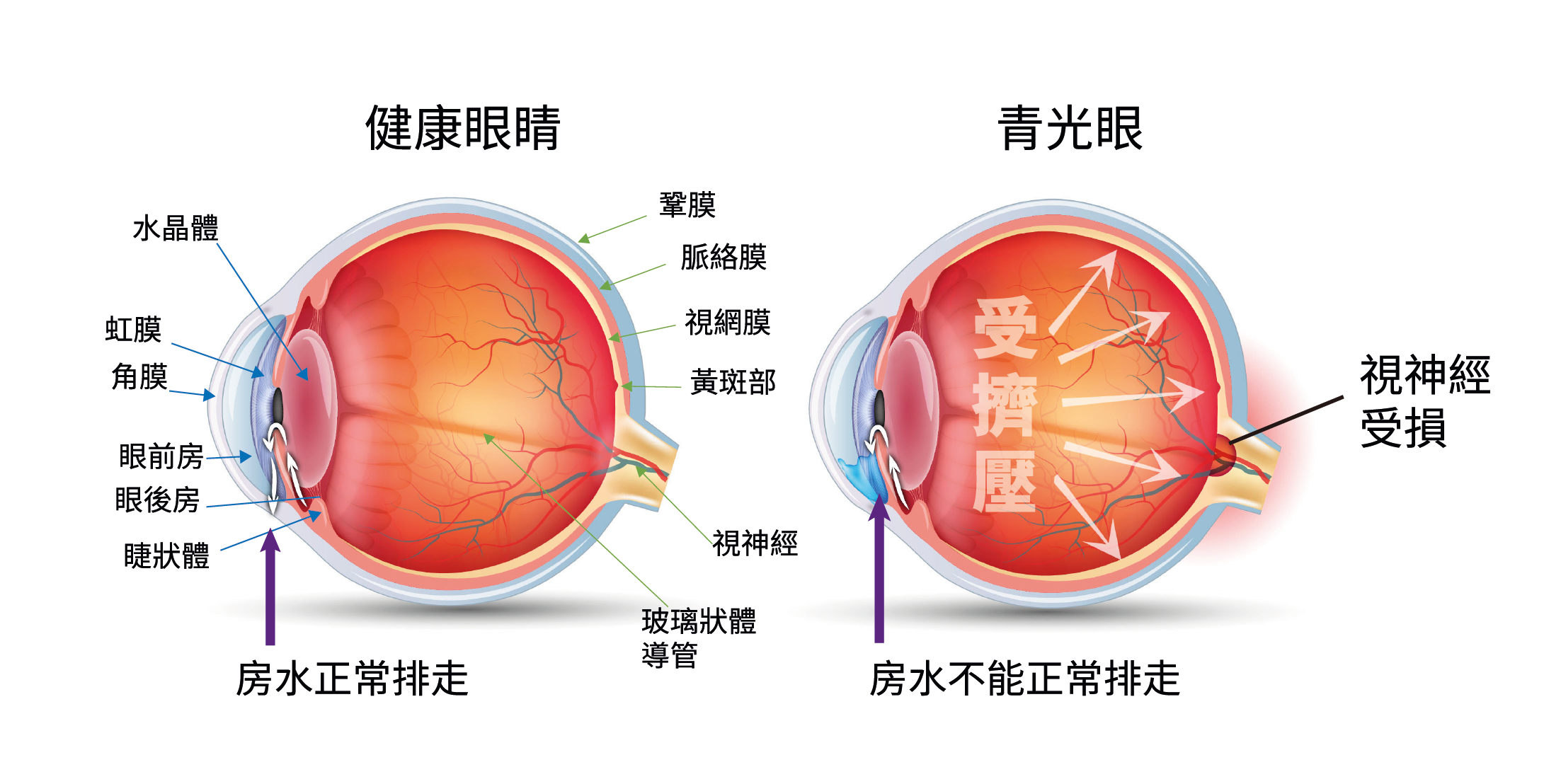 健康眼睛 vs 青光眼