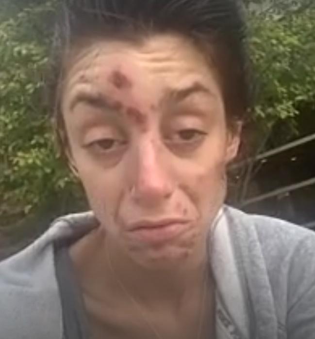 27歲女吸毒爛面爆瘡,戒毒3年後靚爆鏡。(Twitter)