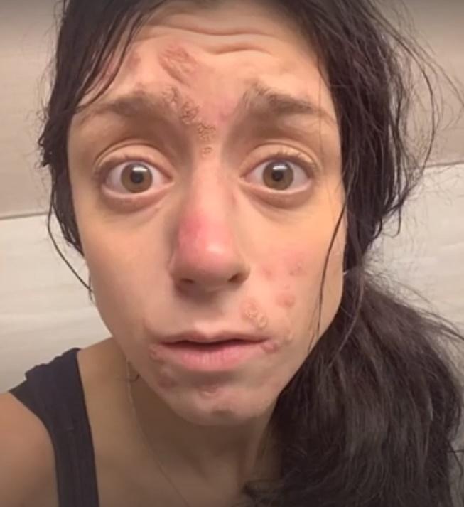 27歲女吸毒爛面爆瘡,戒毒3年後靚爆鏡。(Twitter)