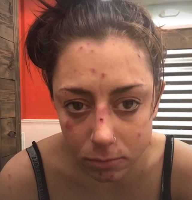 27歲女吸毒爛面爆瘡,戒毒3年後靚爆鏡。(Twitter)