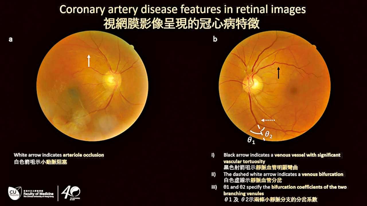 中大新技術 助HIV感染者評估心臟病風險