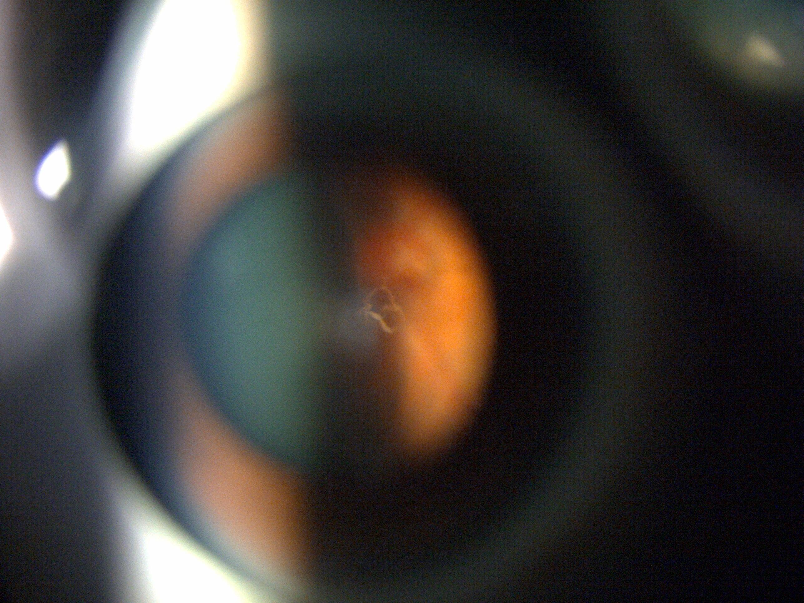 玻璃體後脫離引致出血